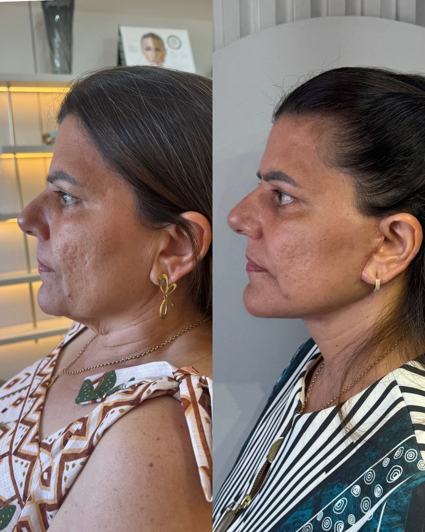 Galeria de resultados: antes e depois
