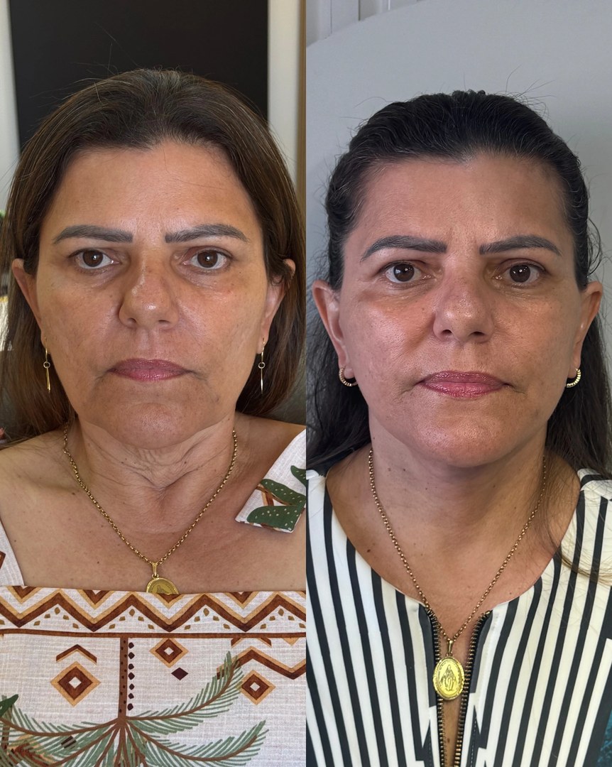 Galeria de resultados: antes e depois