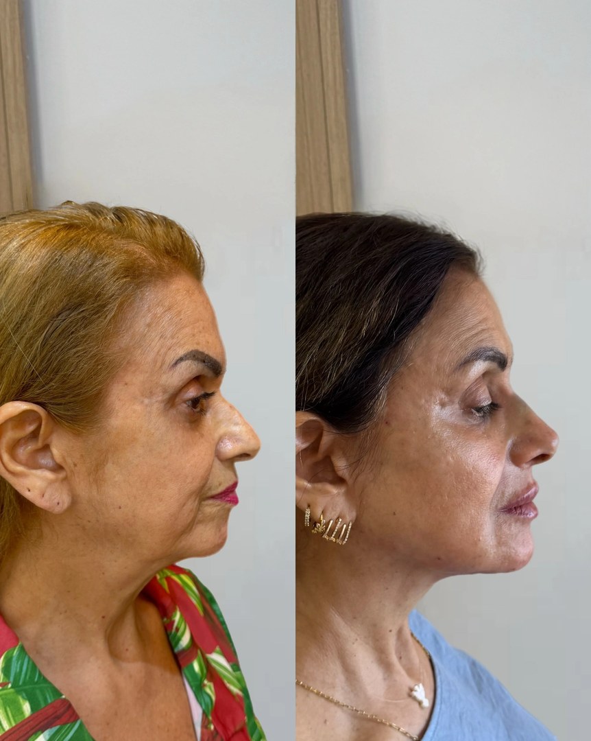 Galeria de resultados: antes e depois