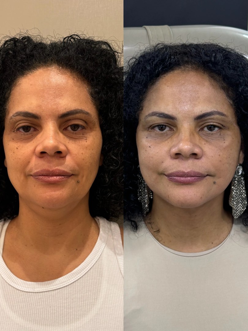 Galeria de resultados: antes e depois